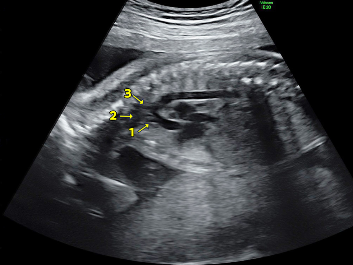 赤ちゃんの大動脈弓