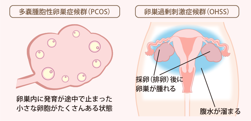 POCSとOHSS