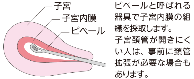 子宮内膜組織採取