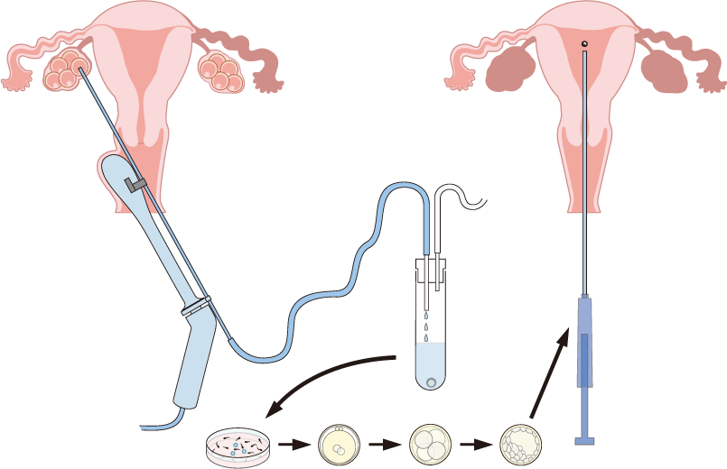 IVF-ETの流れ