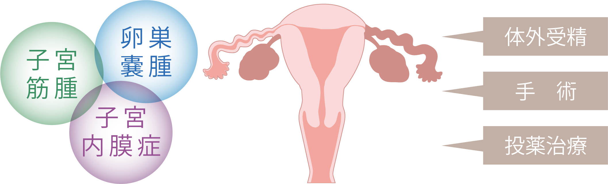 婦人科疾患による不妊治療