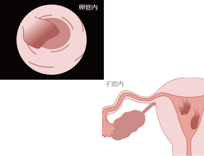 子宮内膜ポリープ