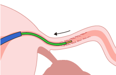 The endoscope is located within the center of the balloon