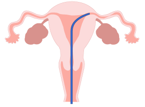 A thin tube called an FT catheter is inserted