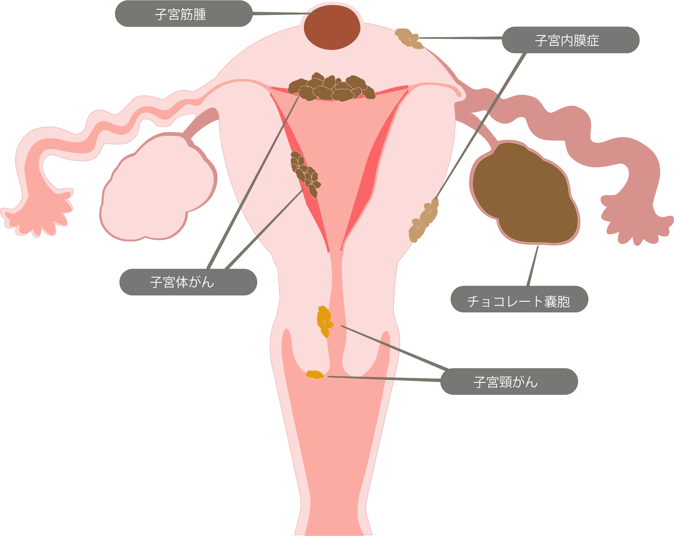 婦人科検診