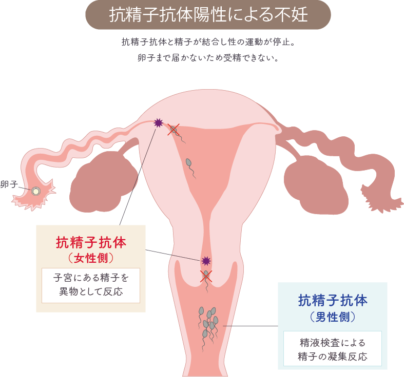 抗精子抗体陽性による不妊