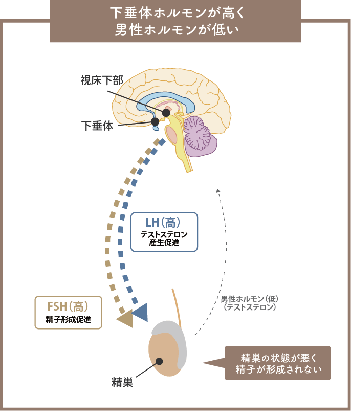 下垂体ホルモンが高く男性ホルモンが低い