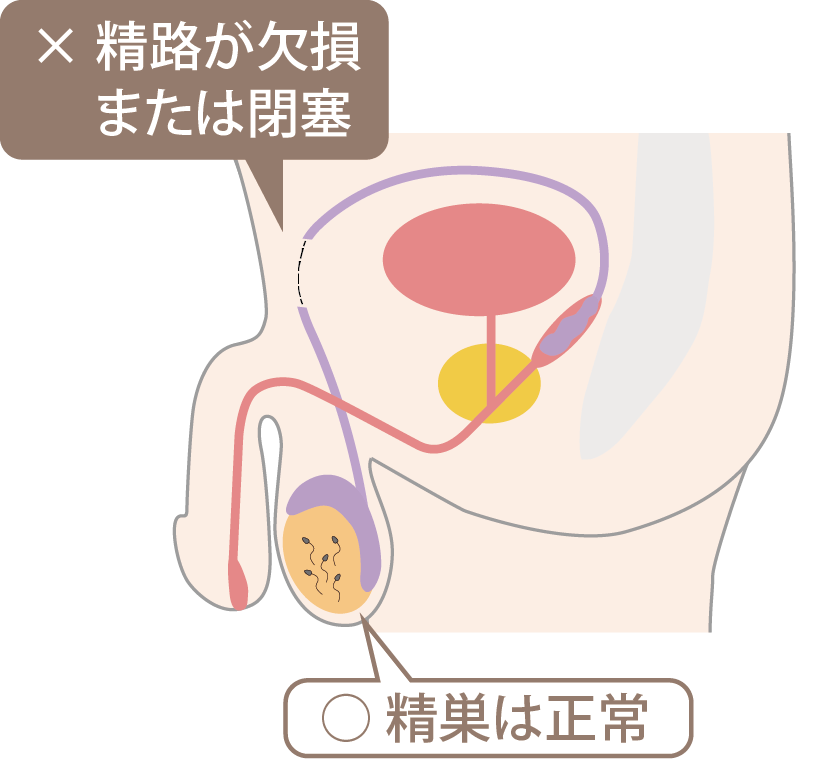 閉塞性無精子症