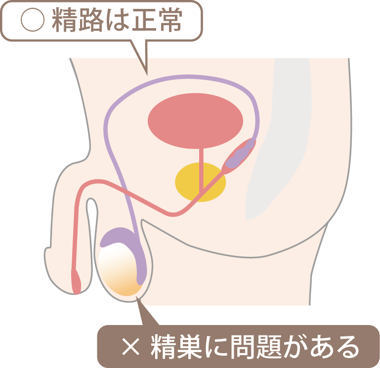 非閉塞性無精子症