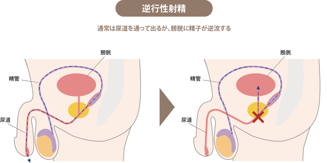 逆行性射精