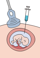 羊水検査の図