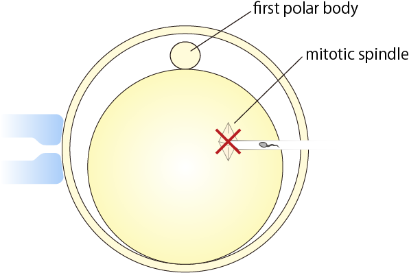 Normal ICSI