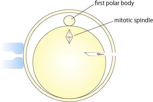 ICSI with Poloscopes