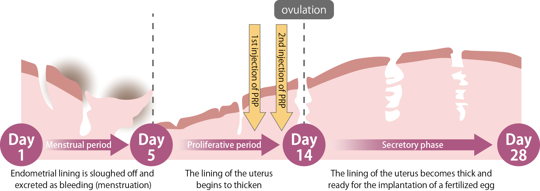 What is PRP therapy