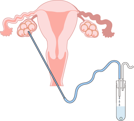 IVF