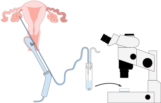 Oocyte Pick-up, Semen Collection