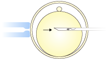 immobile sperm with the ICSI needle