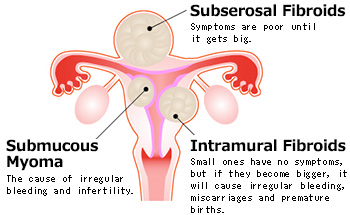 Uterine Myoma⁄ Fibroids