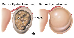 ovarian cyst