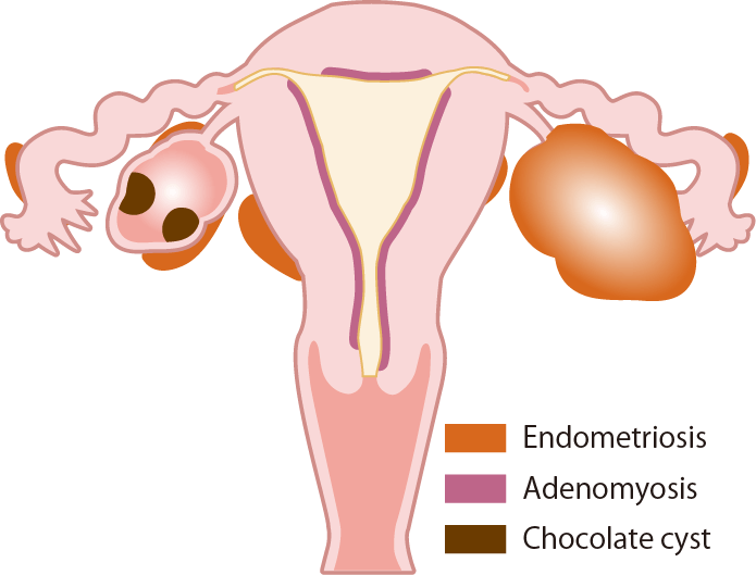 Endometriosis and Adenomyosis