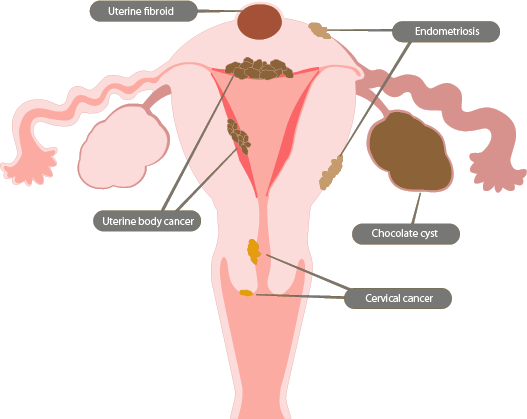 Gynecological Examination