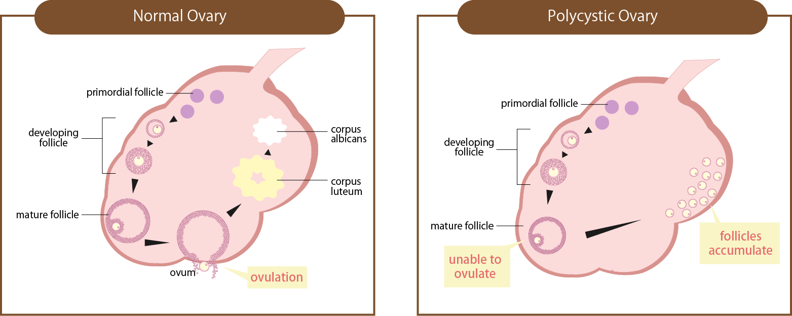 Polycystic Ovary Syndrome