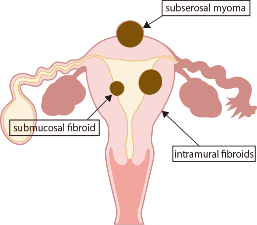 Uterine Fibroids