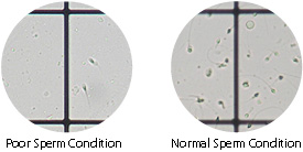 Oligospermia