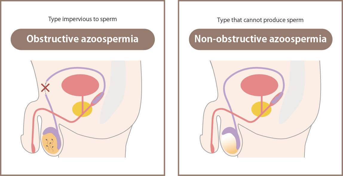 azoospermia obliterans