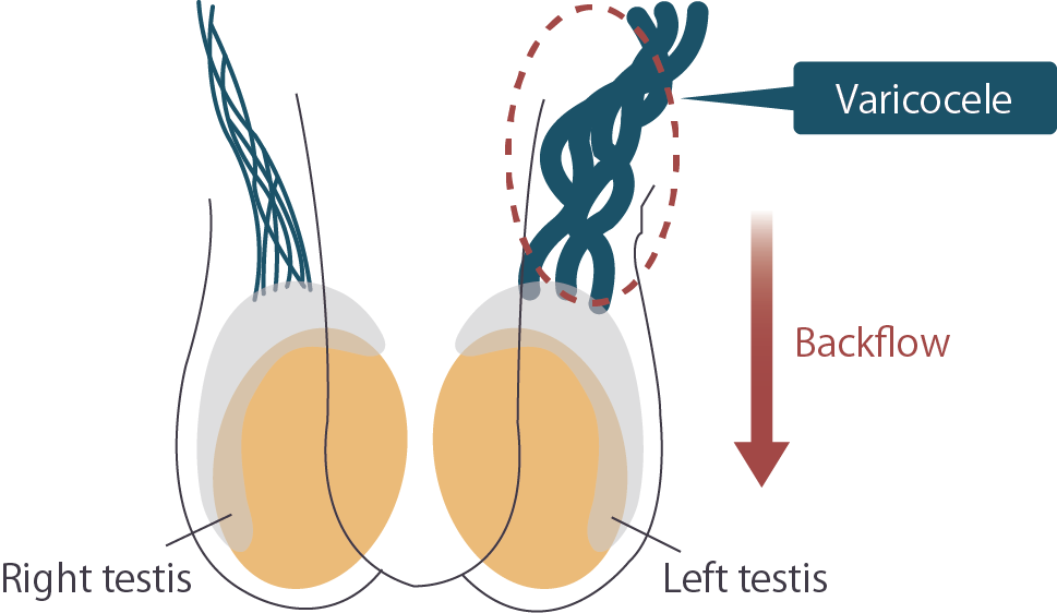 varicocele