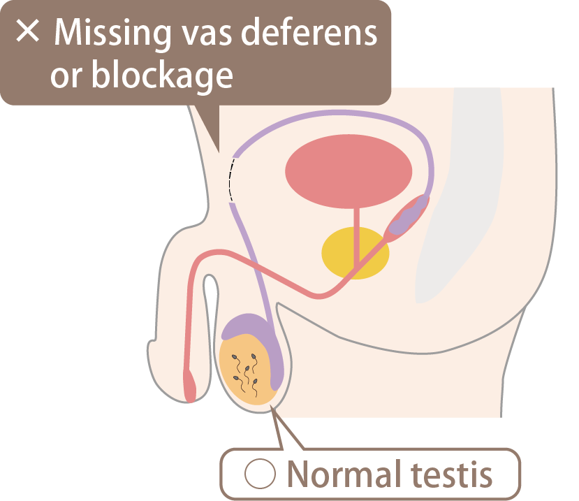 Obstructive azoospermia