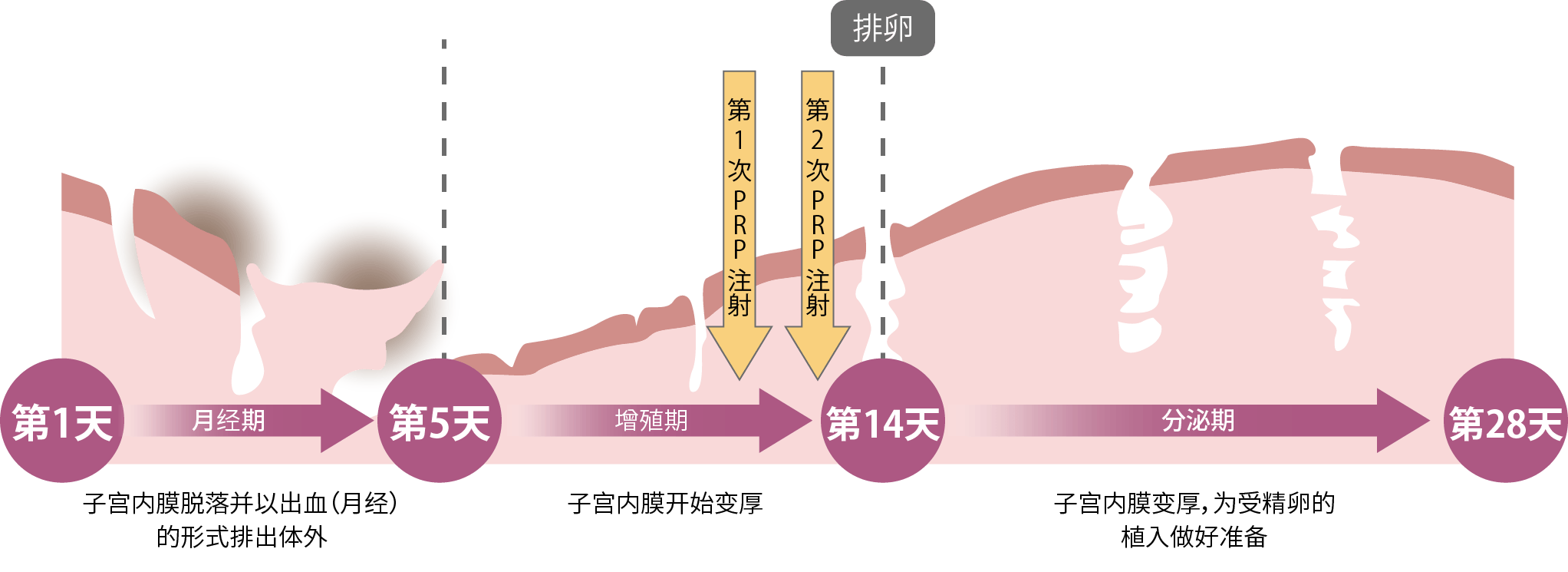 什么是子宫内膜再生富血小板血浆疗法（PRP）