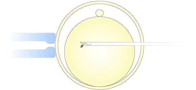 显微授精法ICSI（二代）