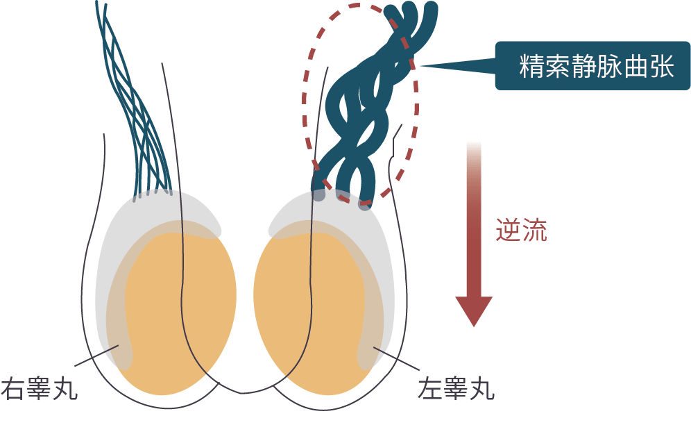 精索静脉曲张