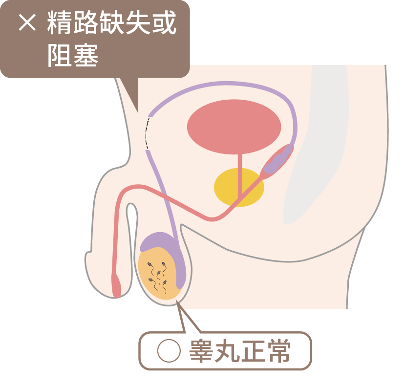 阻塞性无精子症