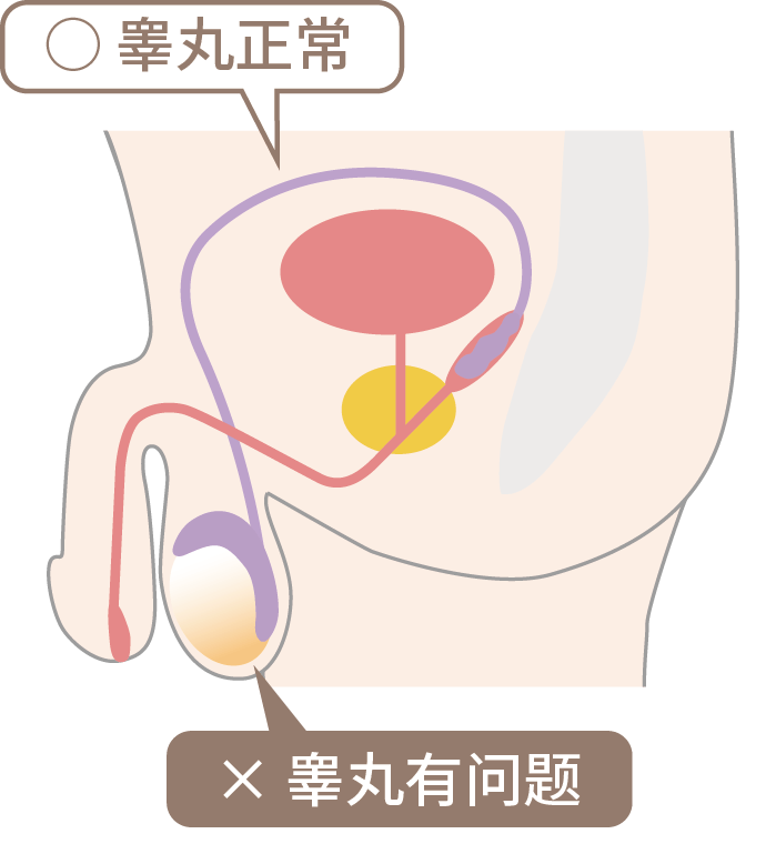 非阻塞性无精子症